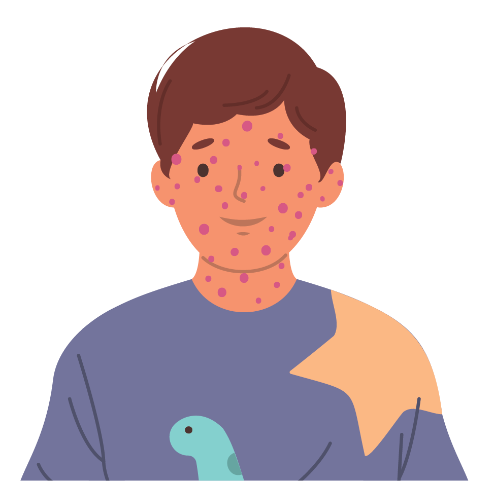 Een jongetje met uitslag van jeukende bultjes op zijn gezicht, veroorzaakt door varicella. Een jongetje met uitslag van jeukende bultjes op zijn gezicht, veroorzaakt door varicella.